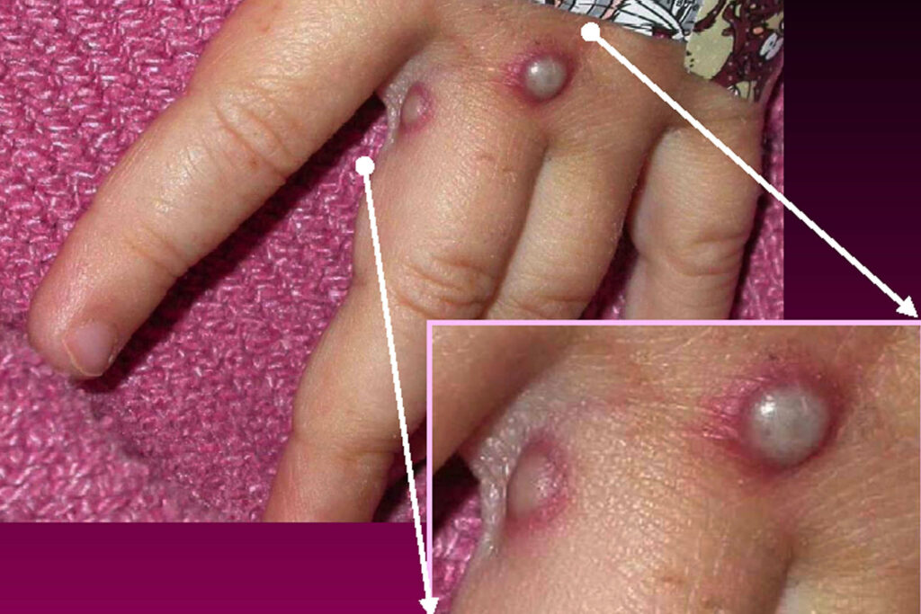 Hands with monkeypox rash