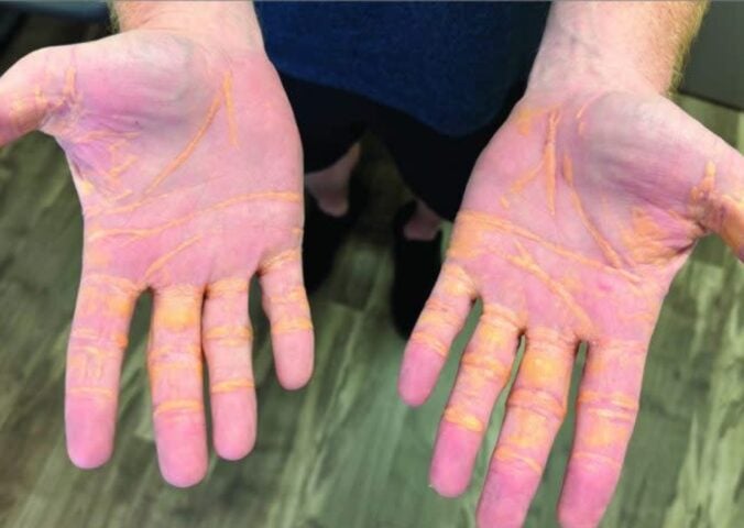 Two hands with xanthelasma, yellowish nodules on the skin, following a carnivore diet