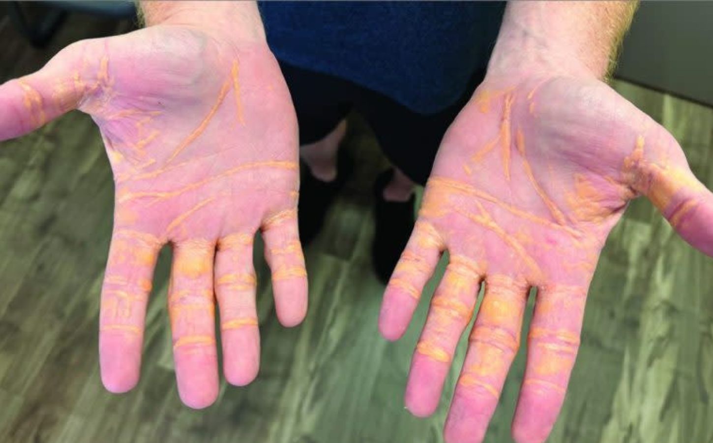 Two hands with xanthelasma, yellowish nodules on the skin, following a carnivore diet